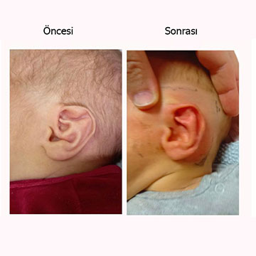 Yeni doğan bebeklerde ameliyatsız kulak şekillendirme